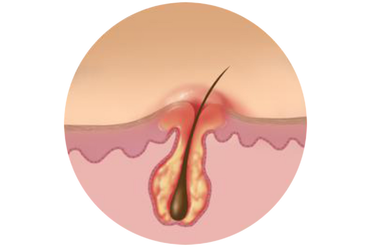 foliculite vaginal
