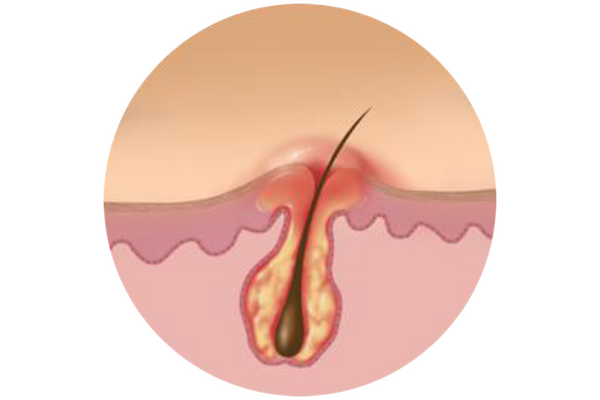 Foliculite vaginal : o que é, causas e como tratar